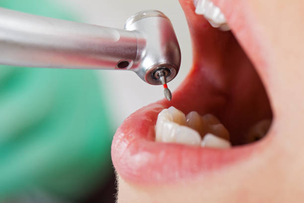 Best Emergency Dental Extractions in Hicksville, OH